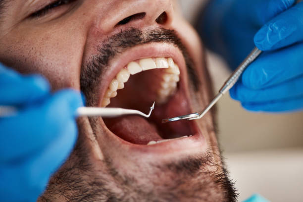 Best Emergency Dental Extractions in Rochester, IL